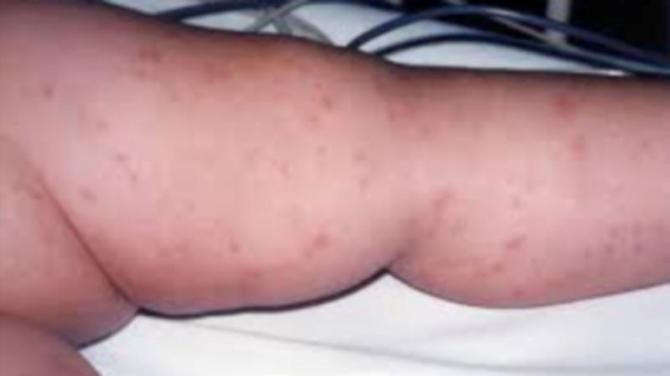Vigilance urged on meningitis